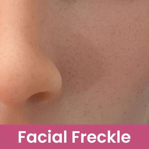 Face freckles [+€49]