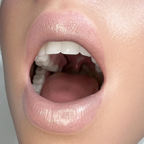 Beweglicher Kiefer mit ROS