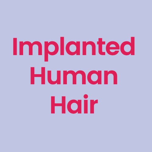Implanted human hair [+$  398]